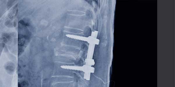 Fracturas vertebrales que Atiende el Dr. Jorge M. Flores