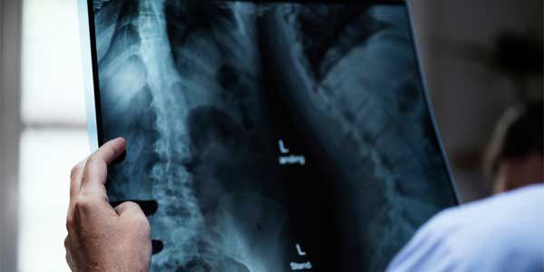 Tumores vertebrales que Atiende el Dr. Jorge M. Flores